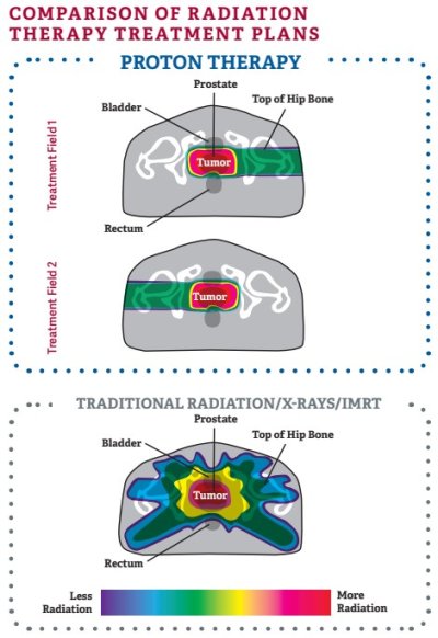 Proton Therapy for Prostate Cancer - Covenant Health